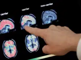 AI modeli, Alzheimer hastalığını yüzde 90’ın üzerinde doğrulukla tespit edebilir